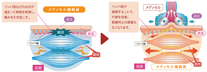 メディセル筋膜療法施術前・施術後図解