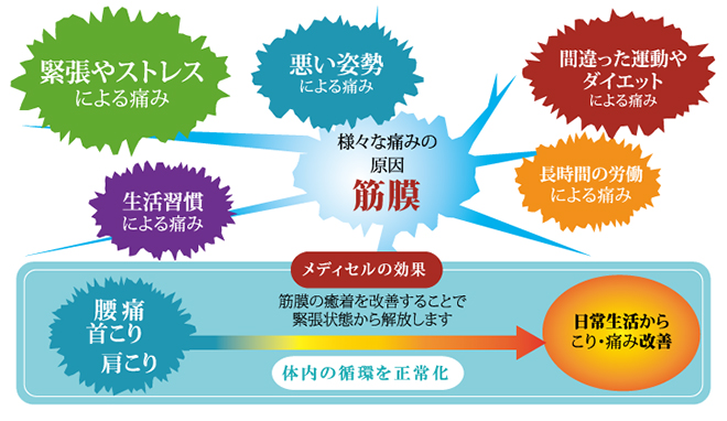 メディセル筋膜療法の効果図解